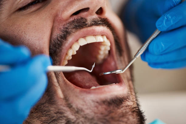 Best Emergency Wisdom Tooth Extraction in Gantt, SC
