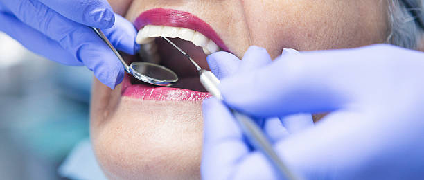 Best Knocked-Out Tooth (Avulsed Tooth) Treatment in Gantt, SC